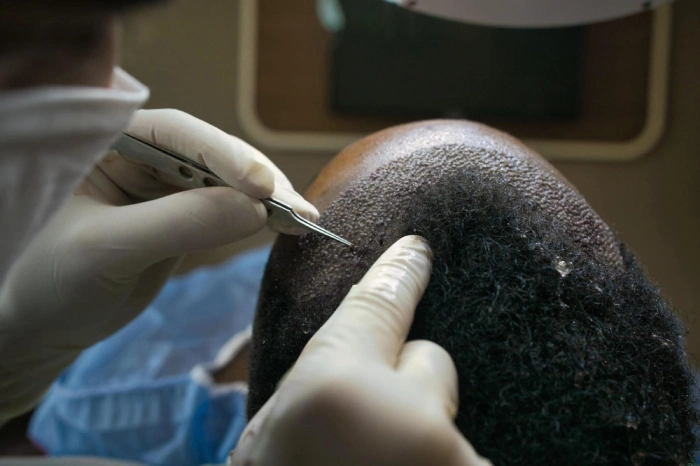 Trasplante de pelo afro en Turquía, trasplante de pelo afro, pelo afro - Trasplante capilar AFRO en Turquía trasplante capilar afro