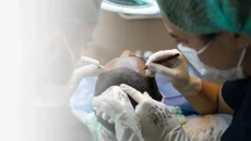 Haartransplantation,haartransplantation türkei​ - Startseite
