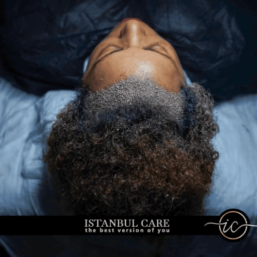 afro-hair-transplant-turkey-cost Trapianto di capelli donna,Trapianto di capelli - Trapianto di capelli donna