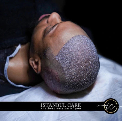 afro-hair-transplant-turkey afro hair transplant turkey