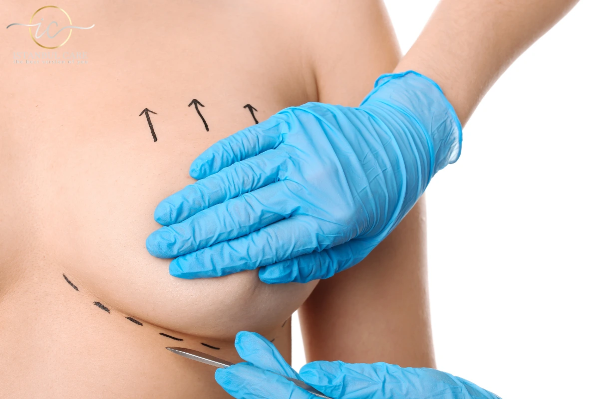 breast-lift-istanbul lifting del seno - Lifting del seno in Turchia