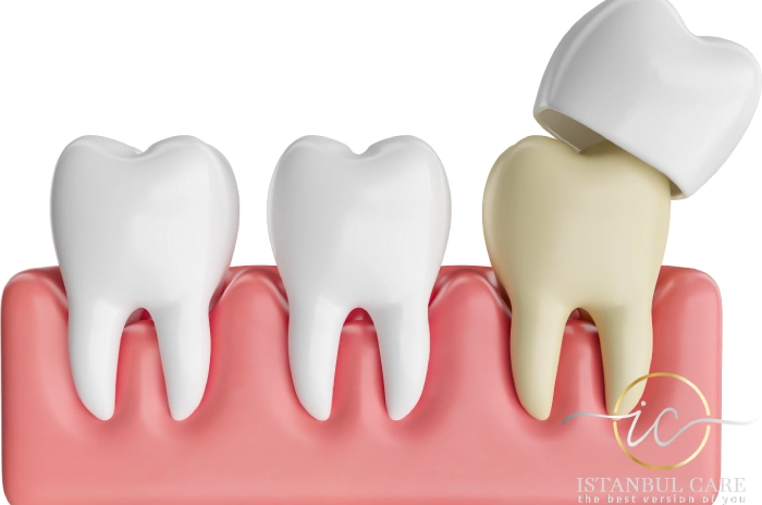 dental-crowns-in-albania Dental Crowns in Albania