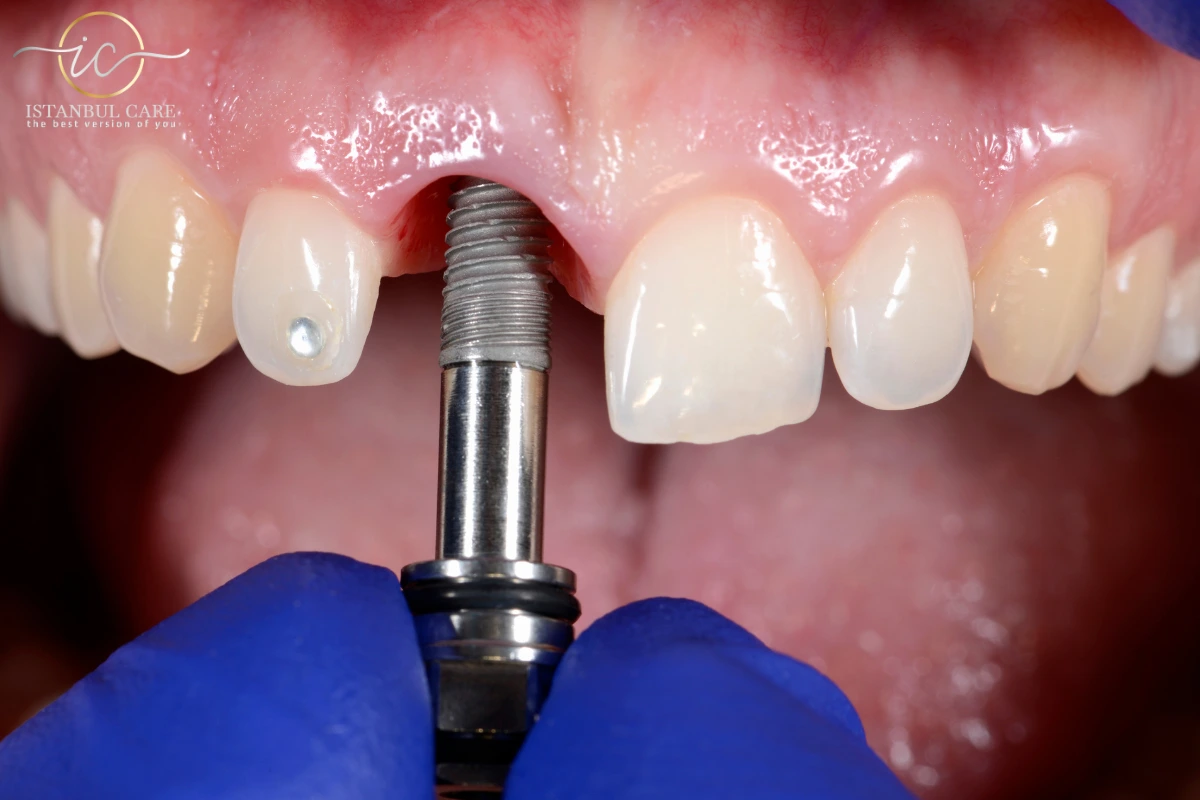 implant dentystyczny w turcji - Koszt implantu dentystycznego w Turcji: bezpieczny i skuteczny implant dentystyczny w turcji - Koszt implantu dentystycznego w Turcji: bezpieczny i skuteczny