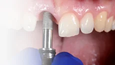 Haartransplantation,haartransplantation türkei​ - Startseite