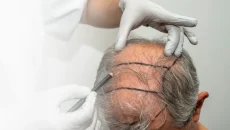 dhi hair transplant cost in turkey