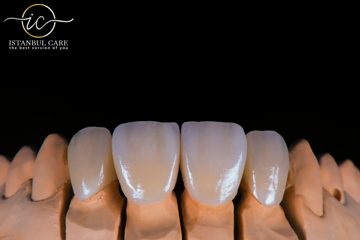 emax-veneers Licówki E-max w Turcji - Licówki E-max w Turcji