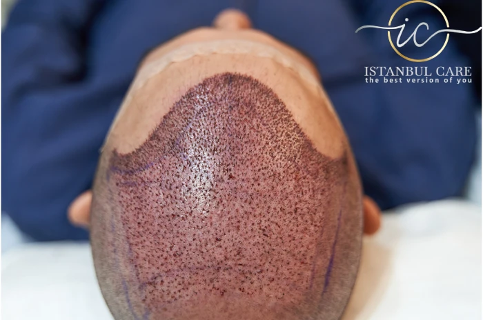 Transplante capilar FUE - Transplante capilar FUE na Turquia