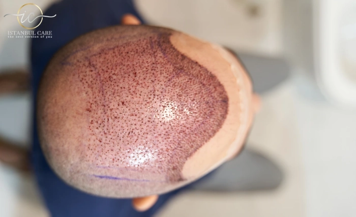 Sapphire FUE Haartransplantation,Haartransplantation - Sapphire FUE Haartransplantation