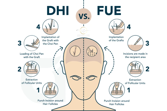 dhi vs fue turkey hair transplant