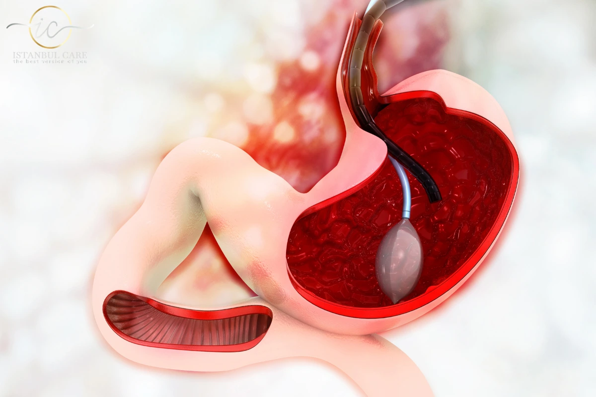 gastric-balloon-in-turkey gastric balloon surgery in turkey
