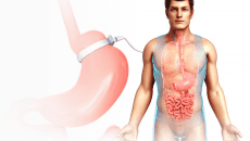 Haartransplantation,haartransplantation türkei​ - Startseite