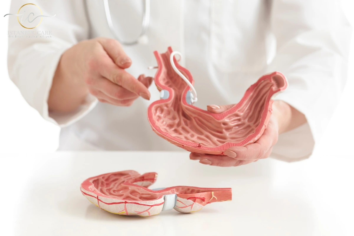 gastric-band gastrectomie sleeve - Gastrectomia Sleeve în Turcia
