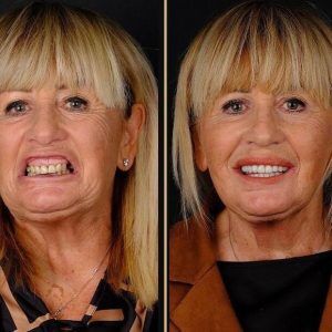 hollywood smile before after in istanbul
