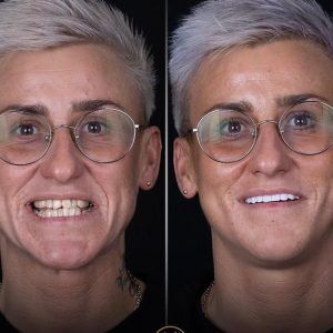 hollywood smile turkey before after