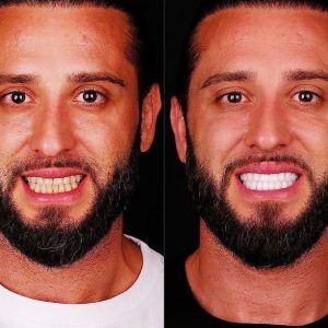 perfect smile before after in Turkey