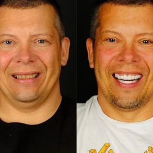dental treatment before after in Turkey