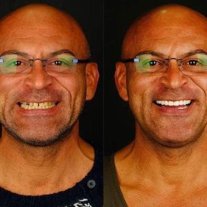 hollywood smile in turkey befor after