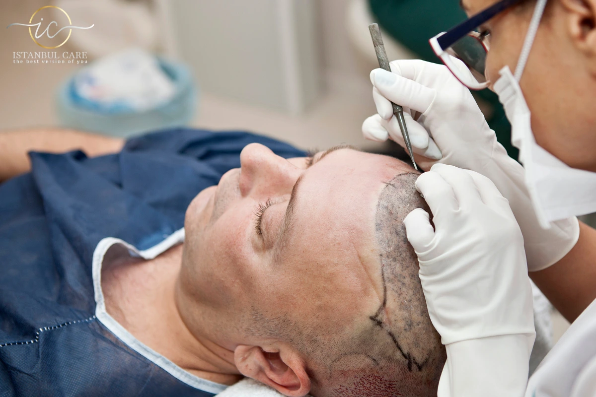 Hair Transplant - How Much Does Hair Transplant Cost in Turkey?