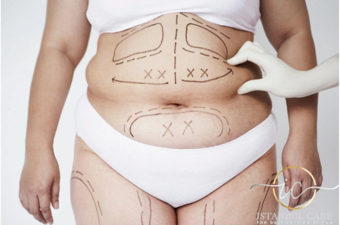 mega-liposuction-turkey Mega Liposuction in Turkey