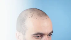 Hair Transplant in Turkey