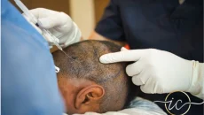 sapphire hair transplant in turkey