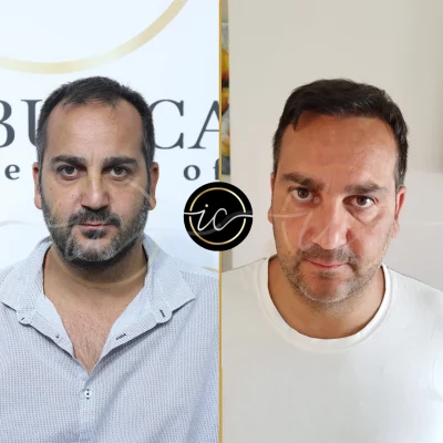 hair transplant before after result
