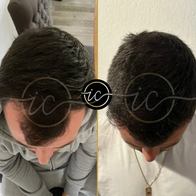 hair transplant before after photos