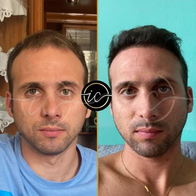 hair transplant before after images
