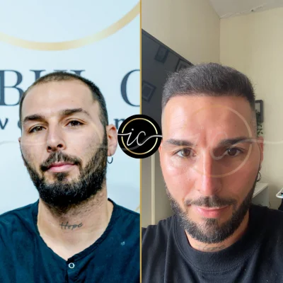 hair transplant before after photo