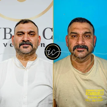 Haartransplantation,haartransplantation türkei - Startseite https://istanbul-care.com/es/costo-del-trasplante-capilar-dhi-en-turquia/