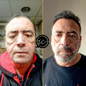 Haartransplantation,haartransplantation türkei - Startseite before after images for hair transplant in turkey