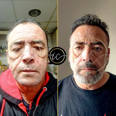 before after images for hair transplant in turkey