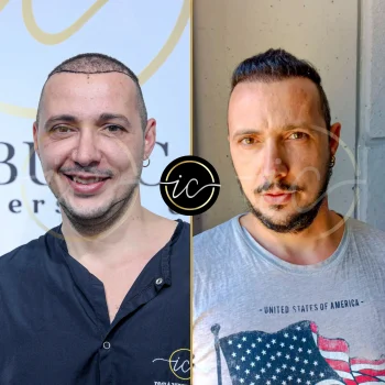 Haartransplantation,haartransplantation türkei - Startseite hair transplant before after istanbul-care