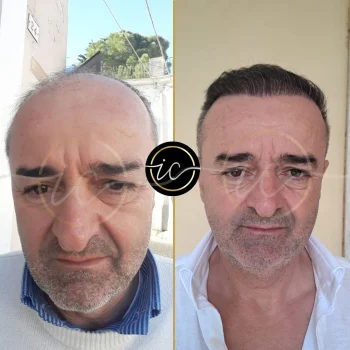 Haartransplantation,haartransplantation türkei - Startseite before after images for hair transplant in turkey