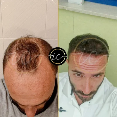 hair transplant before after