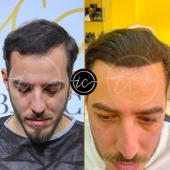 Haartransplantation,haartransplantation türkei - Startseite hair transplant before after istanbul