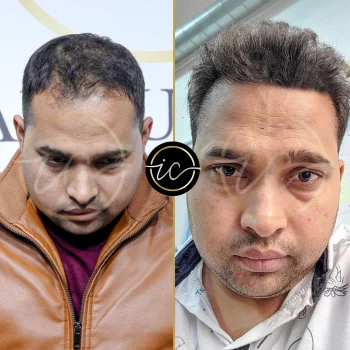 Haartransplantation,haartransplantation türkei - Startseite before after images for hair transplant in Istanbul