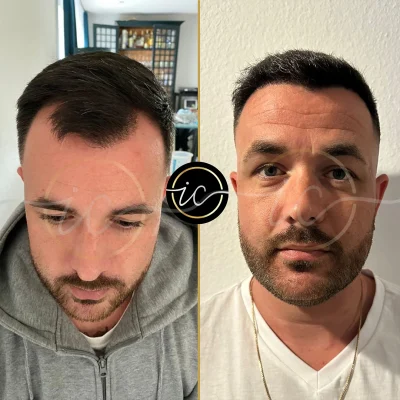 hair transplant before after turkey