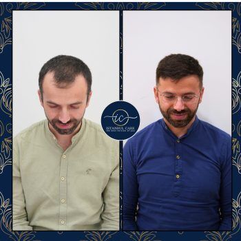 Trapianto di capelli in Turchia,Trapianto di capelli - Casa Trapianto di capelli in Turchia,Trapianto di capelli - Casa