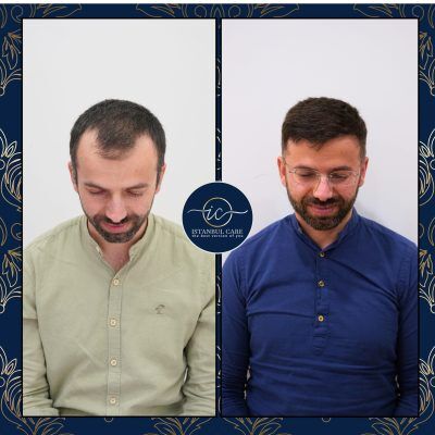 Trapianto di capelli in Turchia,Trapianto di capelli - Casa