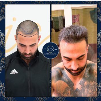 Trapianto di capelli in Turchia,Trapianto di capelli - Casa Trapianto di capelli in Turchia,Trapianto di capelli - Casa