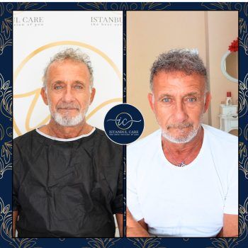 Trapianto di capelli in Turchia,Trapianto di capelli - Casa Trapianto di capelli in Turchia,Trapianto di capelli - Casa