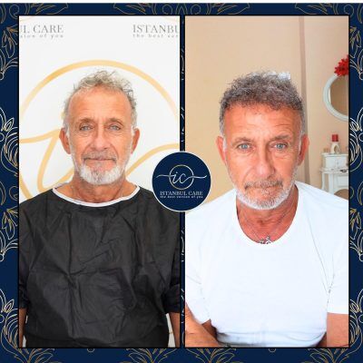 Trapianto di capelli in Turchia,Trapianto di capelli - Casa