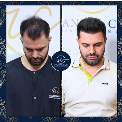 Trapianto di capelli in Turchia,Trapianto di capelli - Casa