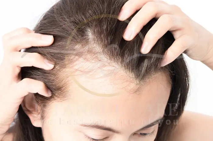 O Mounjaro provoca queda de cabelo