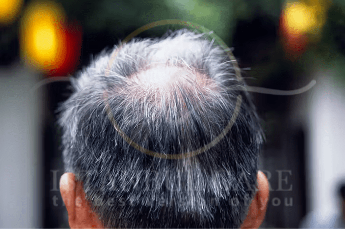 Quelle est l'ampleur normale de la perte de cheveux ?