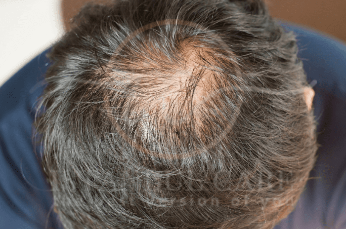 Quelle est l'ampleur de la chute de cheveux normale ? La chute de cheveux quotidienne expliquée