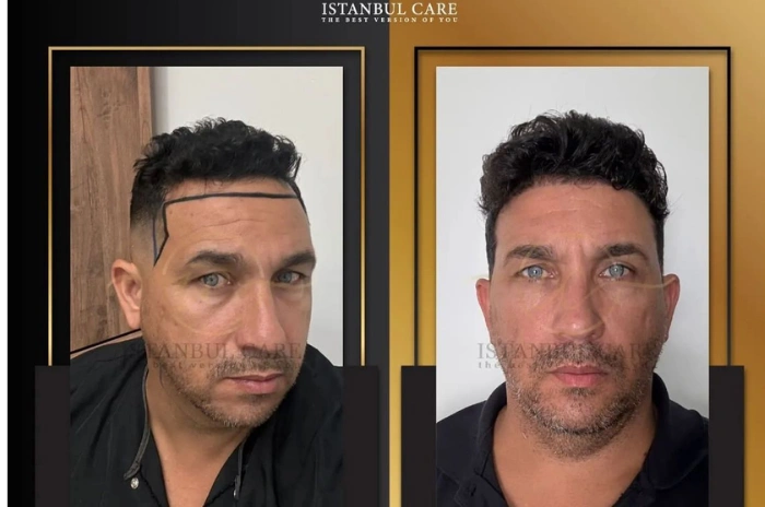 PRP vs hair transplant cost PRP vs hair transplant cost