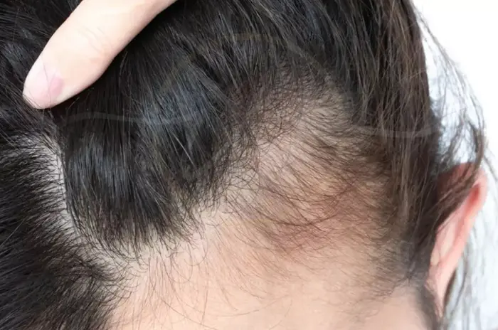 Traction Alopecia and Pattern Hair Loss