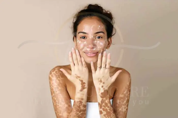 Vitiligo Haar Ursachen und Symptome